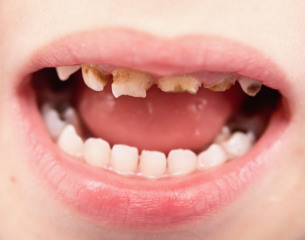 Caries en dientes de leche